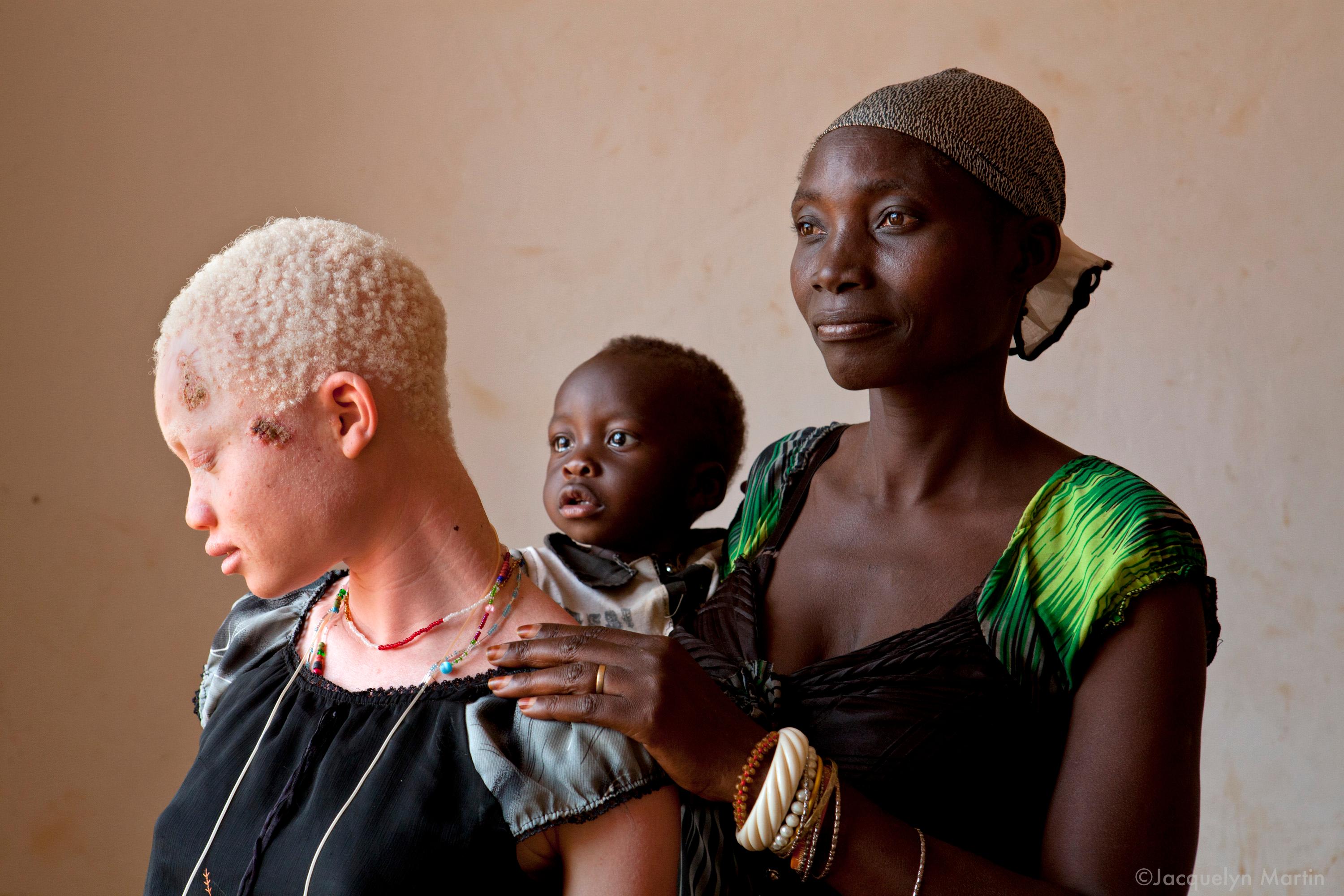Африка белая женщина. Альбинизм негроидная раса.