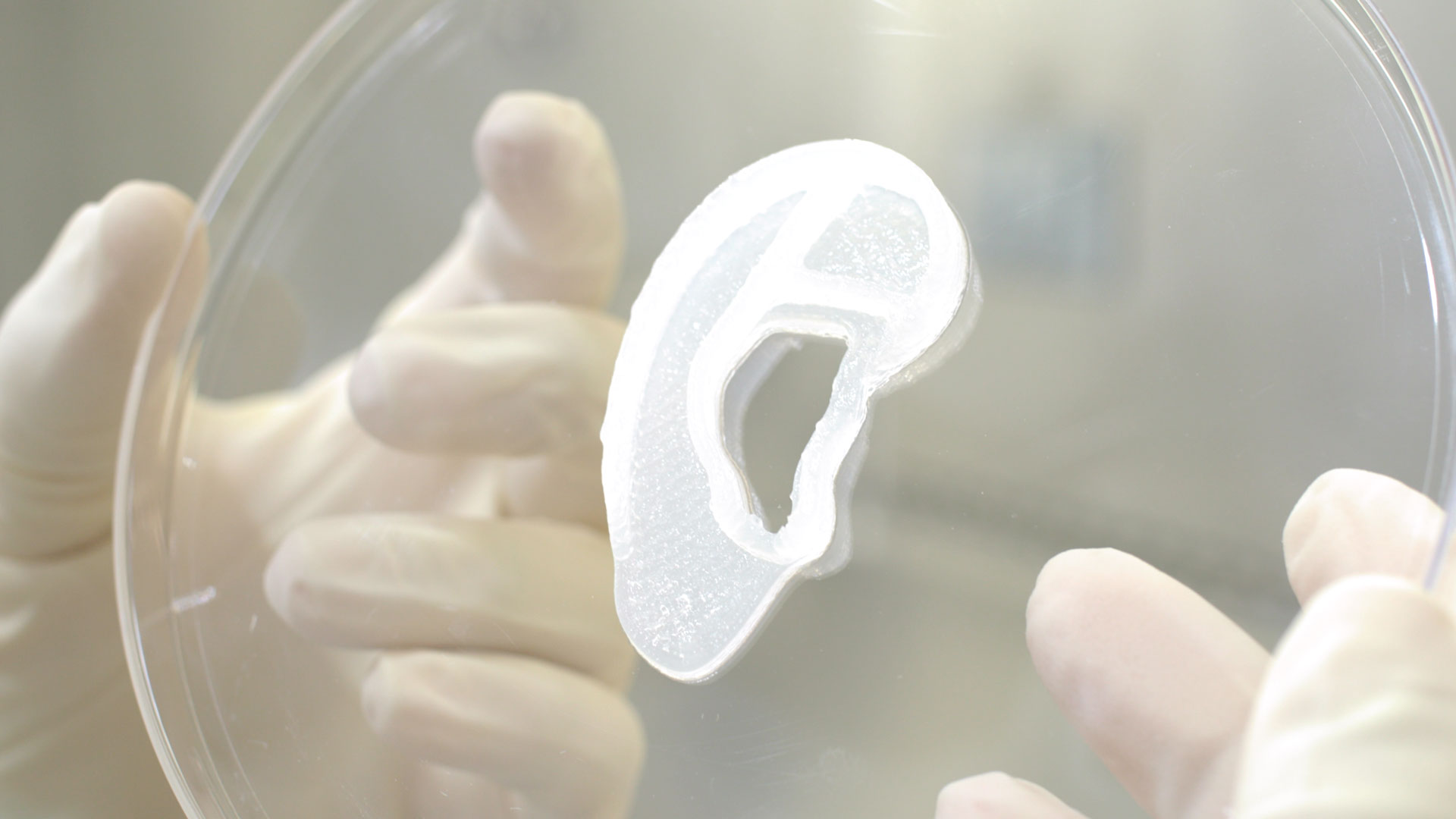 Surgeons Transplant 3-D-Printed Ear Made From Patient's Own Cells | Smart News - Vimarsana News