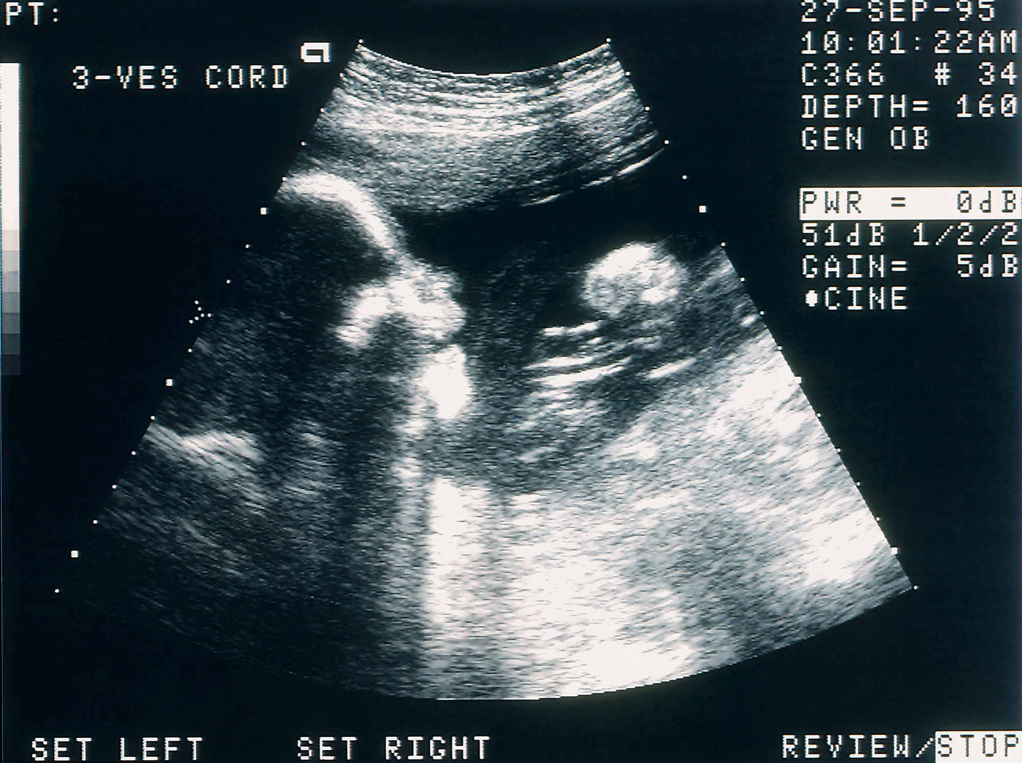 Doctors Treated a Child for a Genetic Disease Before She Was Born | Smart News - Vimarsana News