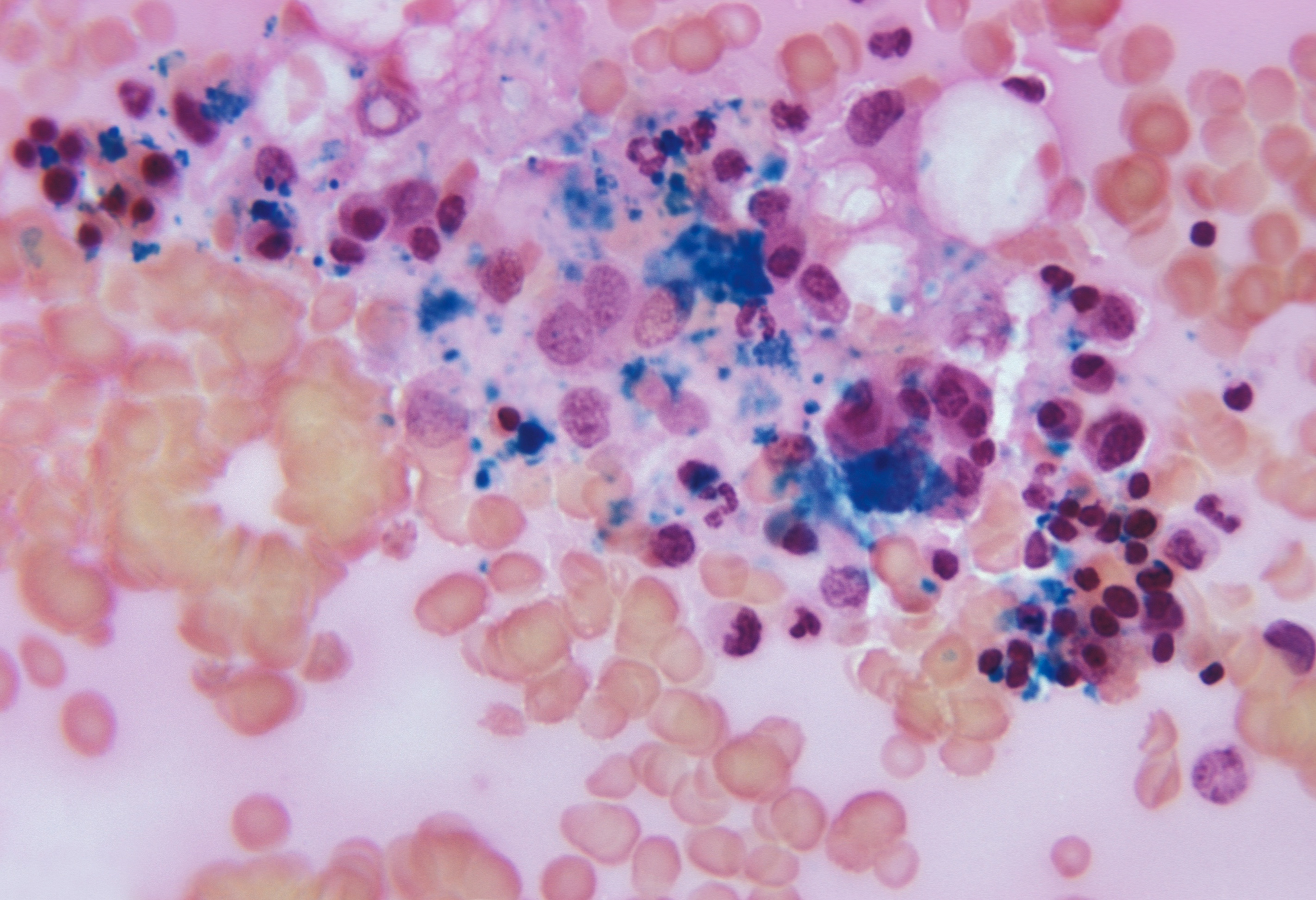 Patient Cured of HIV After Stem Cell Transplant, Researchers Say | Smart News - Vimarsana News