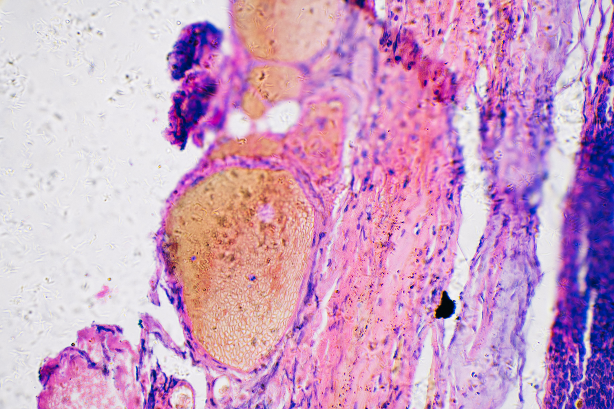 New mRNA Vaccine Shows Promise Against Skin Cancer | Smart News - Vimarsana News