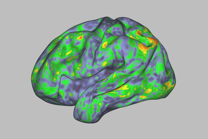 A heat map of brain activity shows stable patterns before and after taking psilocybin in blue and green, while temporary changes are shown in red, orange and yellow.