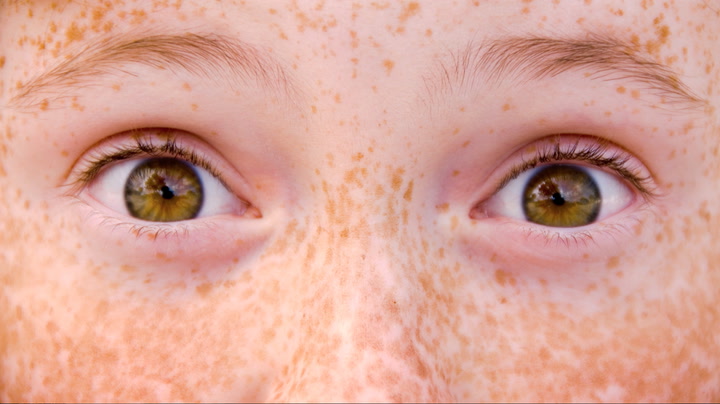  Ask Smithsonian: Whats a Freckle? Smithsonian Magazine